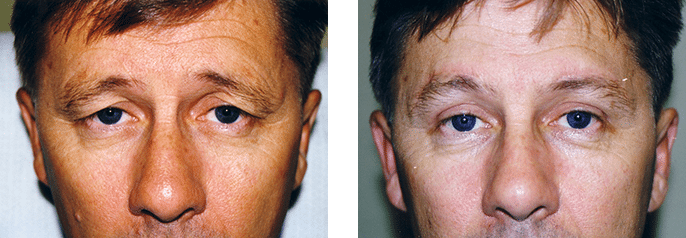 eyelid surgery australia