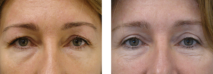 Blepharoplasty Cosmedic and Skin Clinic Paitent_1