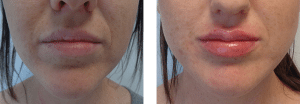 Lip Filler Cosmedic and Skin Clinic Patient 1