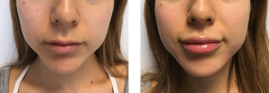 Lip Filler Cosmedic and Skin Clinic Patient 2