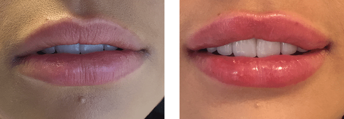 Lip Filler Cosmedic and Skin Clinic Patient 3