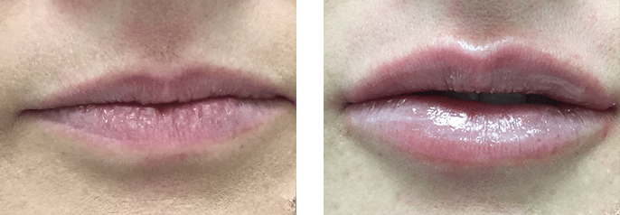 Lip Filler Cosmedic and Skin Clinic Patient 4