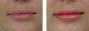 Lip Filler Cosmedic and Skin Clinic | Paitent--5