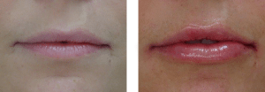 Lip Filler Cosmedic and Skin Clinic | Paitent 6