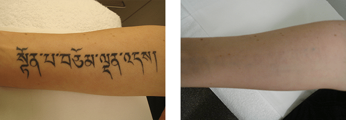 Tattoo Removal | Cosmedic & Skin Clinic | Patient 2
