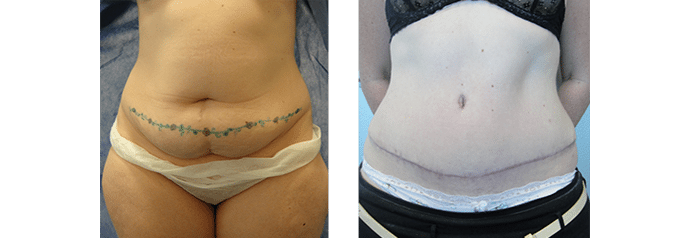 Abdominoplasty Cosmedic and Skin Clinic Patient 2